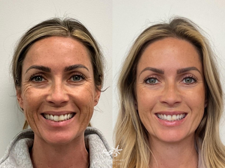 Before and after Botox treatment at La Jolla Cosmetic