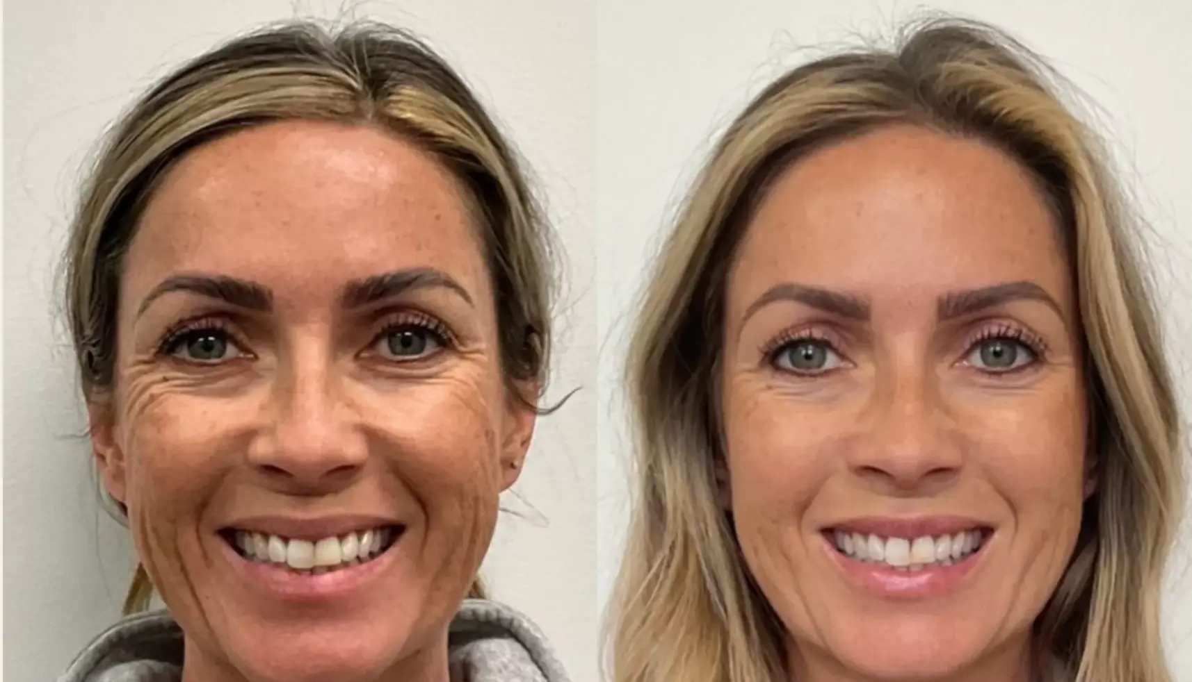 Botox Before & After Result 1