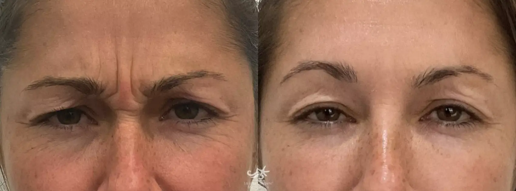 Botox Before & After Result 2