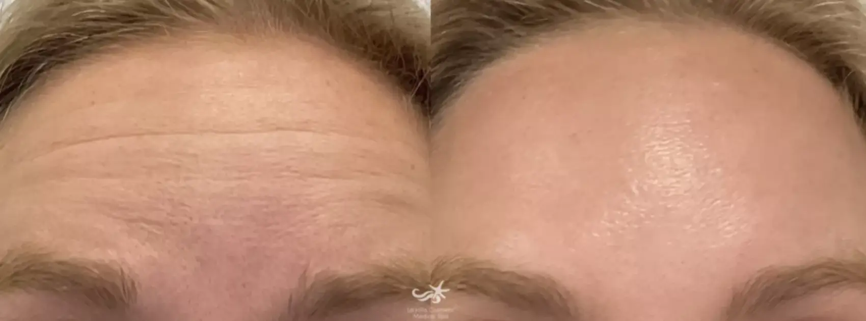 Botox Before & After Result 3