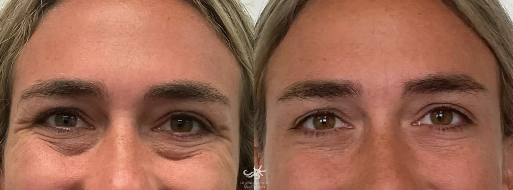 Botox Before & After Result 4