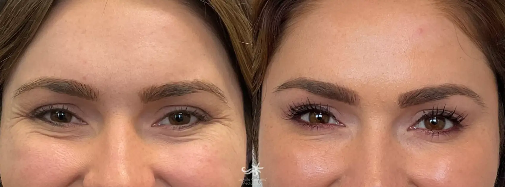 Botox Before & After Result 5